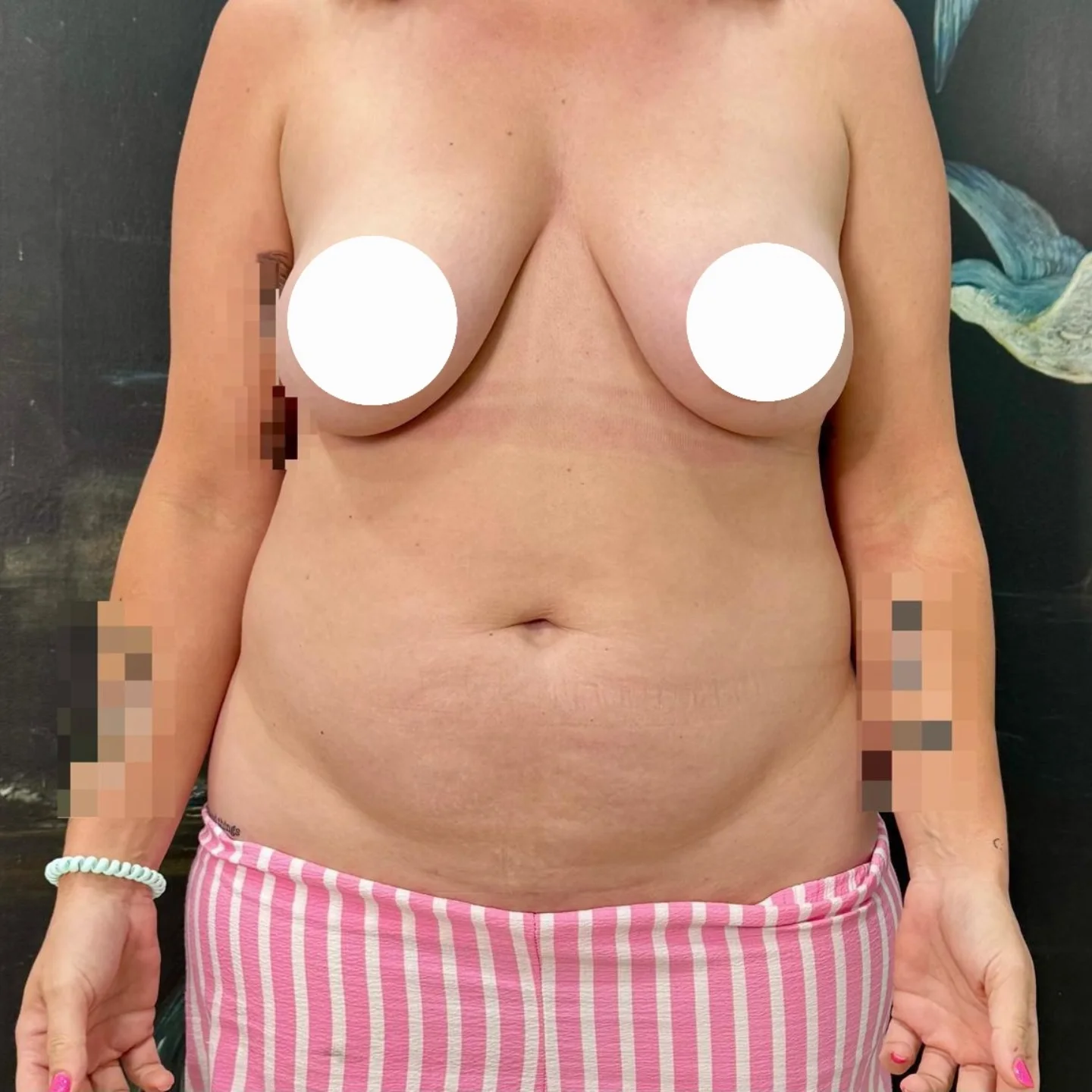 Mommy Makeover Before